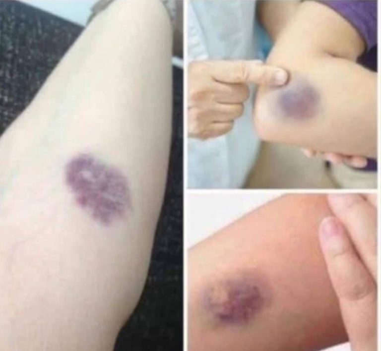 BE CAREFUL, if you get these bruises on your body, it means you have Ca…see more