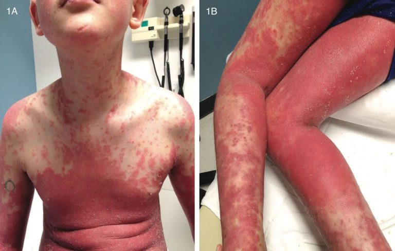 Pediatric Psoriasis Comorbidities