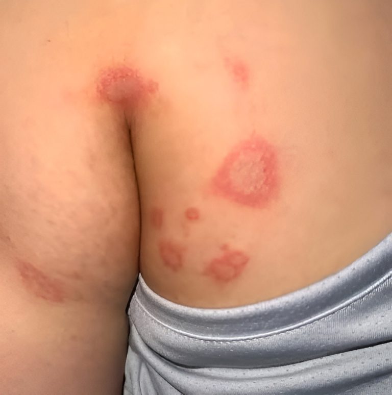 Why Bumps Appear in the Gen!tal Area